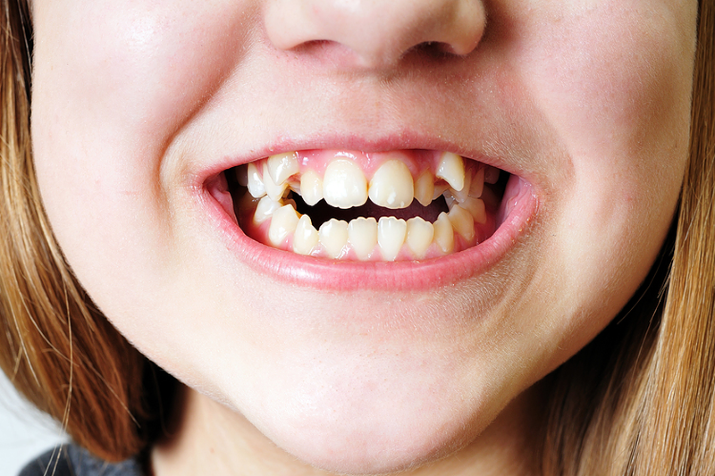 Можно ли есть зубы. Гипердонтия (сверхкомплектные зубы. Гипердонтия аномалия числа зубов.